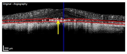 optical coherence tomography angiography